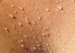 iperidrosi rimini ancona